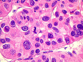 Patología Hepatobiliar y Pancreática