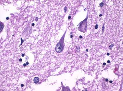 Neuropatología