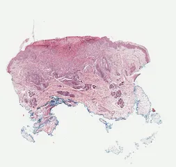 Histiocitosis