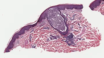 Foliculitis